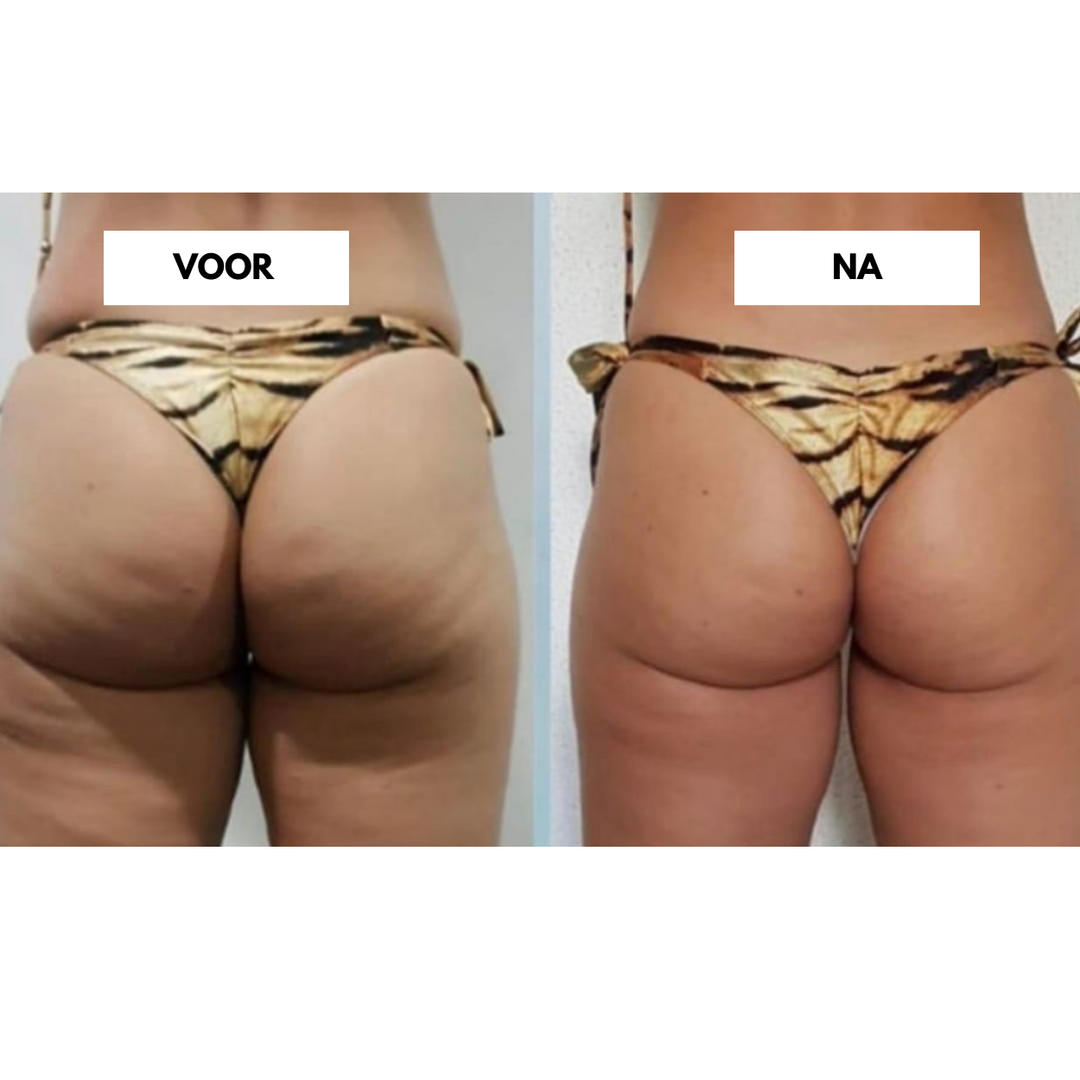 CelluLift™ | Verstevig uw huid met de anti-cellulite vacuüm-massager