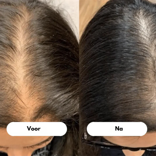 RadiantRoots™ | Ontdek voller haar met de LED-haargroei kam