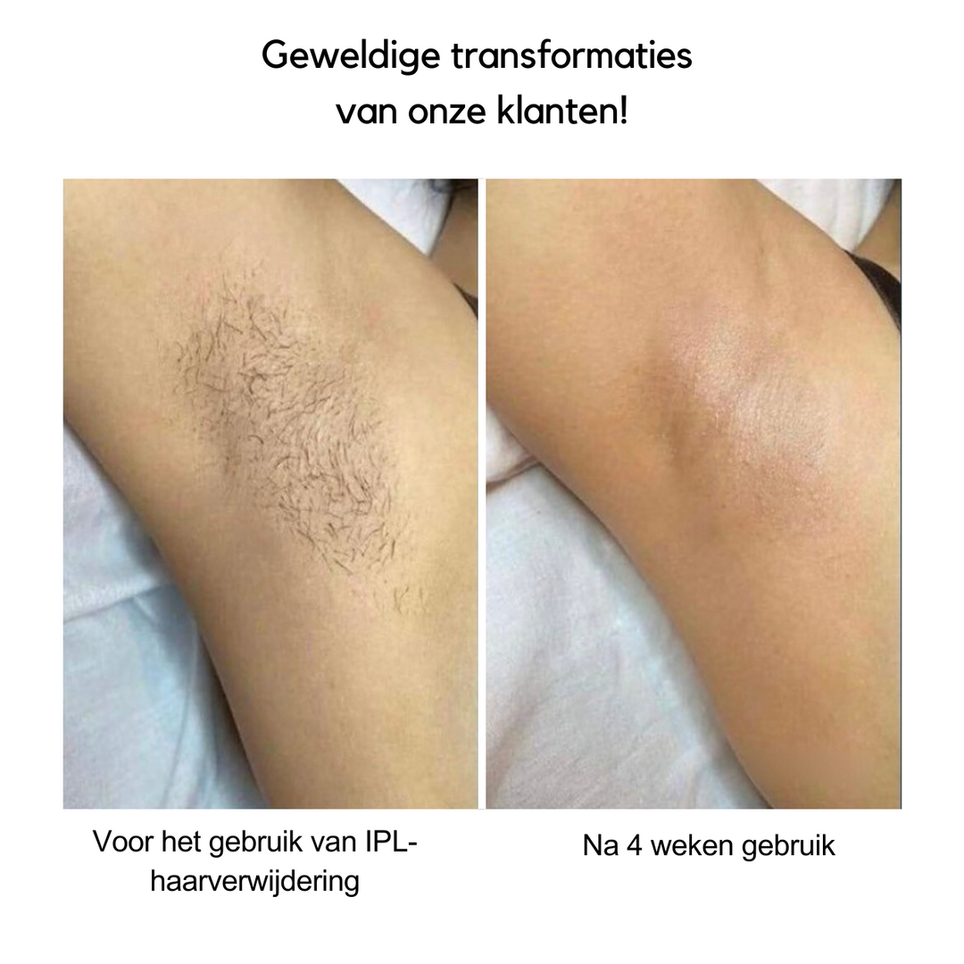 IPL Haarverwijdering™ | Zeg vaarwel tegen ongewenst haar