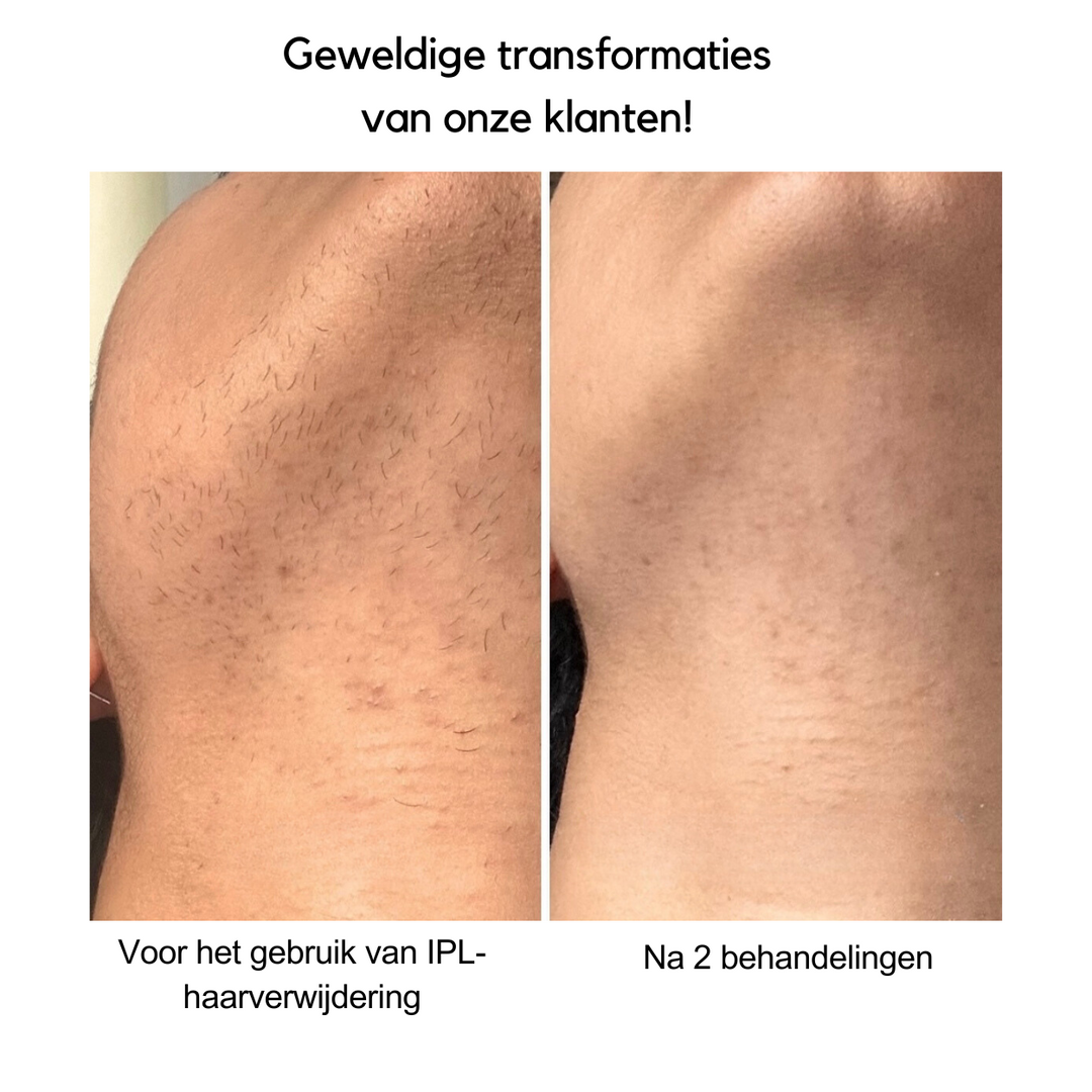 IPL Haarverwijdering™ | Zeg vaarwel tegen ongewenst haar