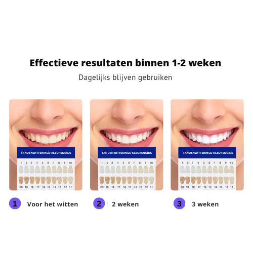 Draadloze Tandenbleking™ | Bleektransformatie voor een stralende glimlach