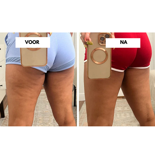 CelluLift™ | Verstevig uw huid met de anti-cellulite vacuüm-massager