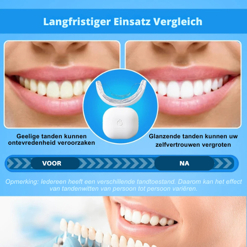 Draadloze Tandenbleking™ | Bleektransformatie voor een stralende glimlach