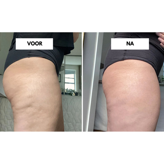 CelluLift™ | Verstevig uw huid met de anti-cellulite vacuüm-massager