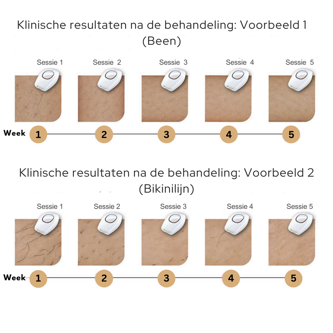 IPL Haarverwijdering™ | Zeg vaarwel tegen ongewenst haar