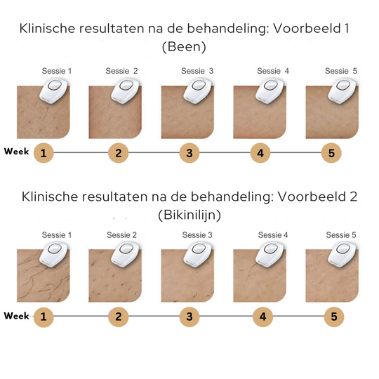 IPL Haarverwijdering™ | Zeg vaarwel tegen ongewenst haar